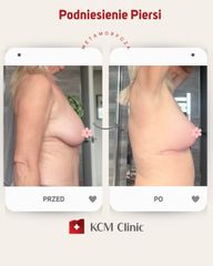Mastopeksja - KCM Clinic Chirurgia Plastyczna i Bariatria