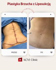 Plastyka brzucha - KCM Clinic Chirurgia Plastyczna i Bariatria
