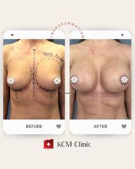 Powiększanie biustu - KCM Clinic Chirurgia Plastyczna i Bariatria