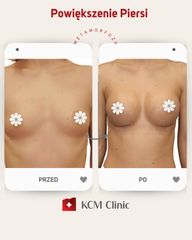 Powiększanie biustu - KCM Clinic Chirurgia Plastyczna i Bariatria