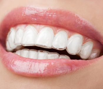 3 tipi di apparecchi dentali invisibili