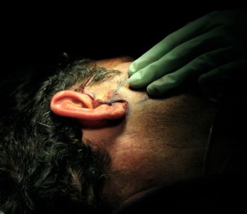 L'intervento di otoplastica