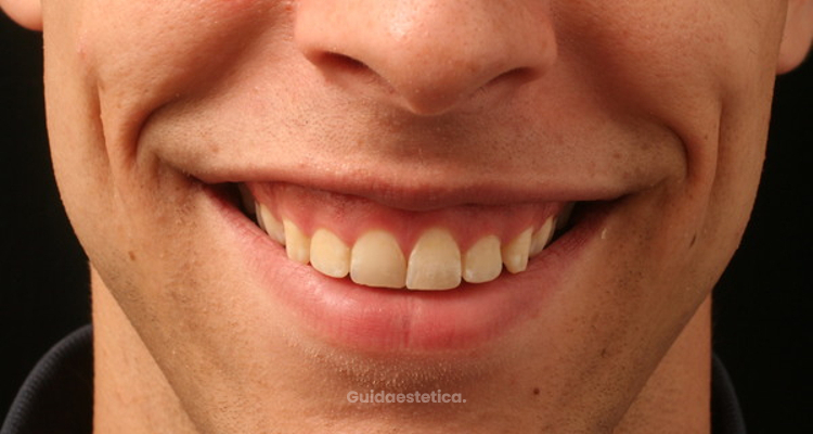 Approccio combinato Botulino/Filler per la soluzione del gummy-smile