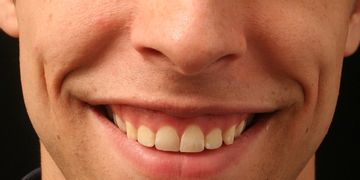 Approccio combinato Botulino/Filler per la soluzione del gummy-smile