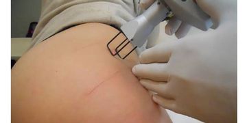 Il trattamento delle smagliature con il laser Il trattamento delle smagliature con il laser