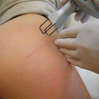 Il trattamento delle smagliature con il laser