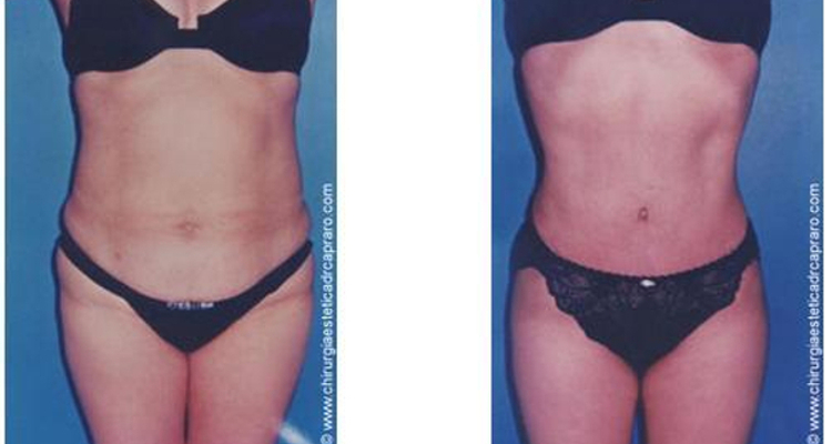Liposuzione e liposcultura, intervista al Dr. Antonio Capraro