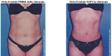 Liposuzione e liposcultura, intervista al Dr. Antonio Capraro