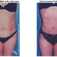 Liposuzione e liposcultura, intervista al Dr. Antonio Capraro