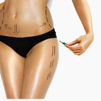 Liposuzione e liposcultura, intervista al Dr. Antonio Capraro