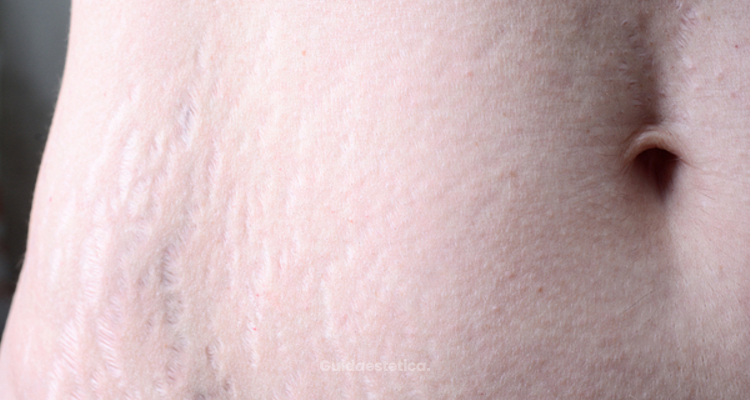 Finalmente la soluzione per eliminare le smagliature - Guidaestetica.it ...