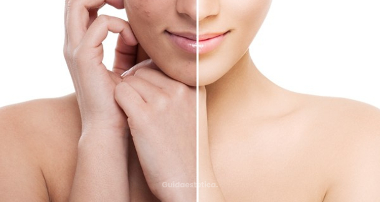 Eliminare i segni dell’acne con il PRX-T33