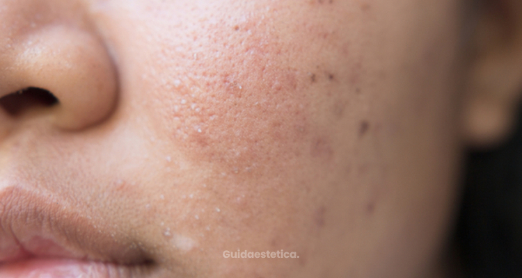 Accutane (isotretinoina), la soluzione miracolosa per l'acne?