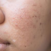 Accutane (isotretinoina), la soluzione miracolosa per l'acne?