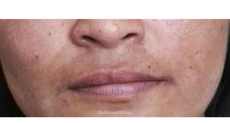 Iperpigmentazione del labbro superiore: le cause e i rimedi più efficaci