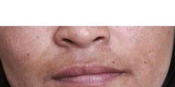 Iperpigmentazione del labbro superiore: le cause e i rimedi più efficaci