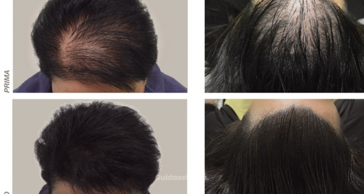 Alopecia e Dintorni: studio personalizzato sul trattamento