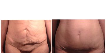 Differenze, vantaggi e svantaggi dei vari interventi di Chirurgia intima femminile Differenze, vantaggi e svantaggi dei vari interventi di Chirurgia intima femminile