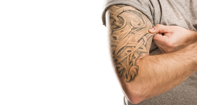 Rimozione tatuaggi: laser o chirurgia?