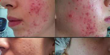 Trattamento dell'acne con il PRX-T33