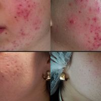 Trattamento dell'acne con il PRX-T33