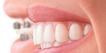 Ortodonzia, quanto mi costi?