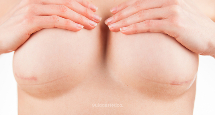 ​Tipologia di cicatrici in seguito a un intervento per l'aumento del seno e cure