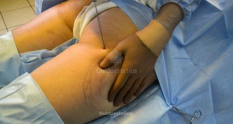 Lipoaspirazione con Body Tite