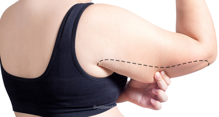 La liposuzione delle braccia è efficace come la brachioplastica?
