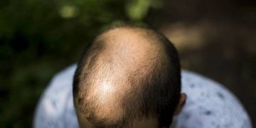 Il trapianto dei capelli con la tecnica innovativa FUE