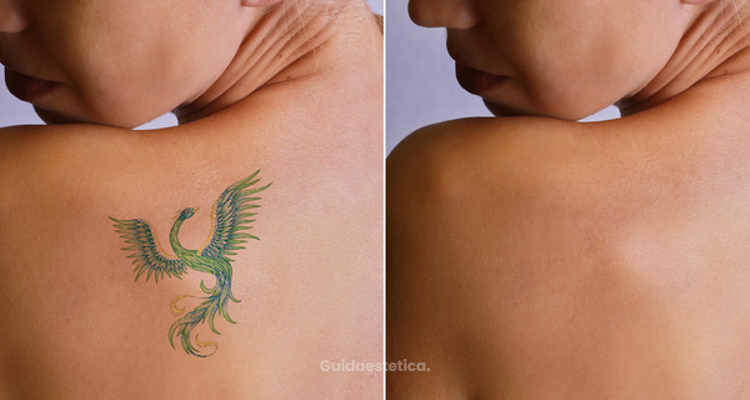 Rimozione tatuaggio con Alma Lasers Neodimio-Yag Q Switch
