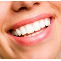 Pro e contro dello sbiancamento denti laser