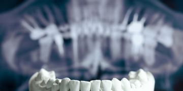 Implantologia mini invasiva computer guidata ed alta estetica dentale