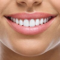 Sbiancamento dentale: le cose da sapere