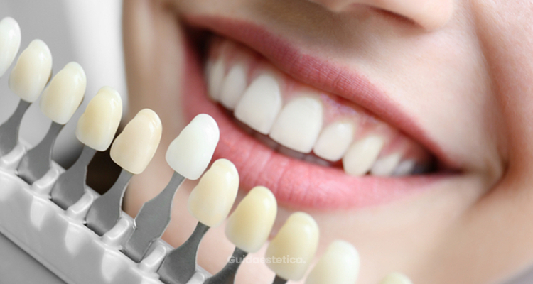 Faccette dentali: vantaggi e svantaggi del sorriso da star