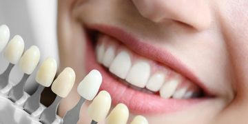 Faccette dentali: vantaggi e svantaggi del sorriso da star