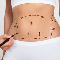 Ossigenazione iperbarica nella chirurgia estetica