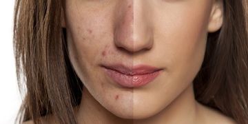 Combattere la secchezza della pelle durante i trattamenti contro l'acne
