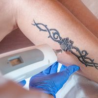 Il laser e l'ablazione dei microfagi aiutano a eliminare i tatuaggi in sicurezza