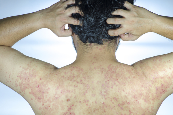 Psoriasi: Come Curarla Durante L'estate E Non Solo - Guidaestetica.it