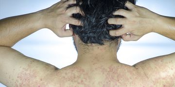 Psoriasi: come curarla durante l'estate e non solo