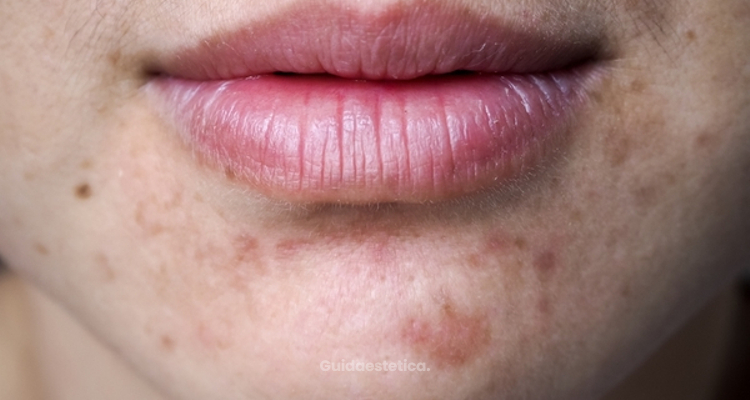 Come eliminare l'acne: i migliori consigli e trattamenti