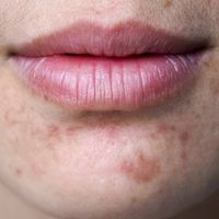 Come eliminare l'acne: i migliori consigli e trattamenti