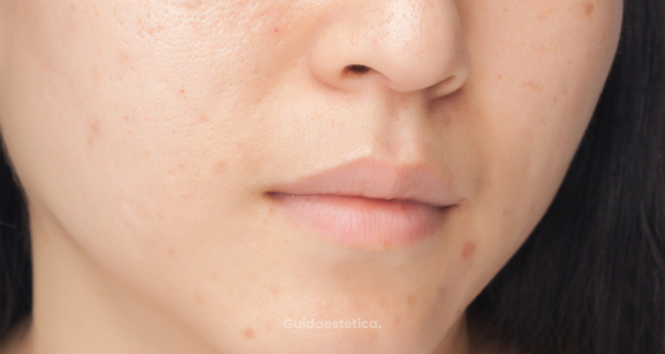 Quanti tipi di acne esistono?