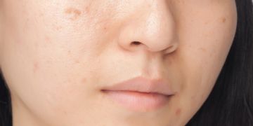 Quanti tipi di acne esistono?