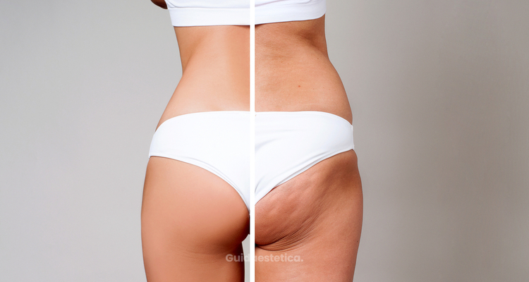 Trattamenti enzimatici: la novità per la cellulite