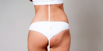 Trattamenti enzimatici: la novità per la cellulite Trattamenti enzimatici: la novità per la cellulite