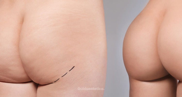 Il signore delle Gluteoplastiche