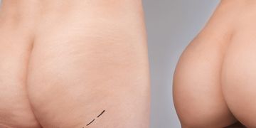 Il signore delle Gluteoplastiche