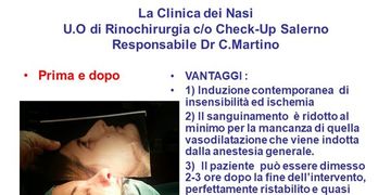 Rinoplastica: tecnica ibrida in anestesia locale